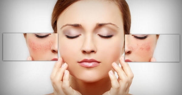 Viên uống trắng da, trị nám Gluta White Plus có gây tác dụng phụ không?