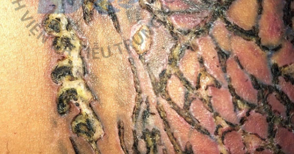 Viêm loét da sau xóa xăm tại thẩm mỹ viện