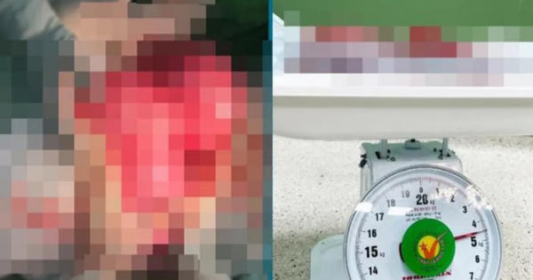 'Sợ dao kéo', người phụ nữ để khối u nặng gần 5kg, chèn lên nội tạng