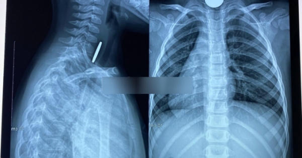 Gắp thành công dị vật trong họng bệnh nhi