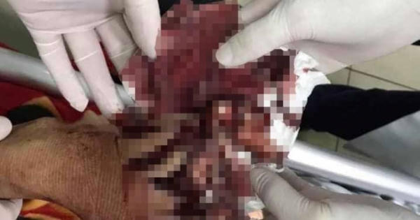 Nổ lớn tại chung cư ở TP Vinh, 1 người nát bàn tay Nổ lớn tại chung cư ở TP Vinh, 1 người nát bàn tay