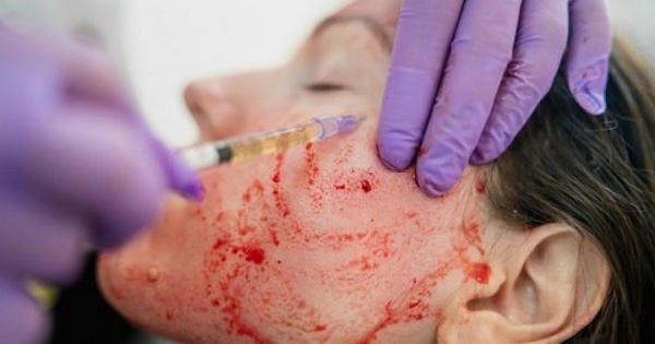 Bác sĩ Bệnh viện Da liễu Trung ương: "Không nên thần thánh hoá phương pháp làm đẹp bằng máu"