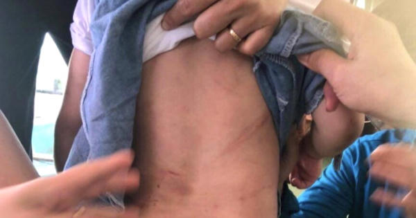 Biếng ăn, bé 3 tuổi bị dì ruột dùng móc áo, cán chổi lau nhà đánh gây thương tích