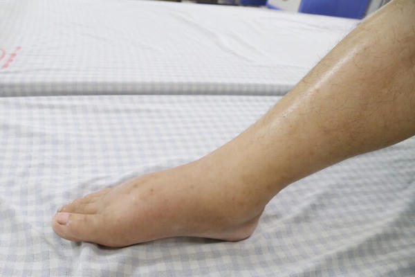 Uống thuốc nam không rõ nguồn gốc, người đàn ông bị phù nề toàn thân