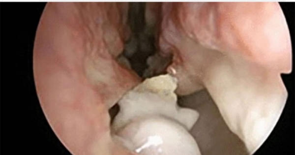 Bác sĩ cũng sốc: Răng mọc trong... lỗ mũi