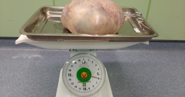 Phẫu thuật bóc tách khối u nặng gần 6kg ra khỏi cơ thể người phụ nữ