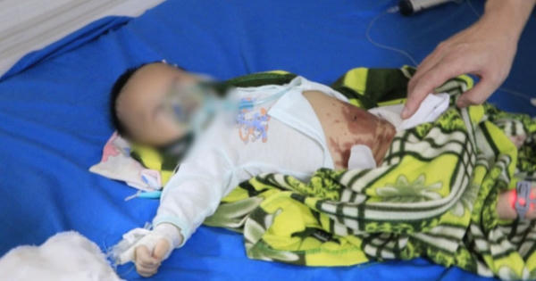 Đắp tỏi điều trị COVID-19, bé 2 tháng tuổi co giật, tím tái, nguy kịch