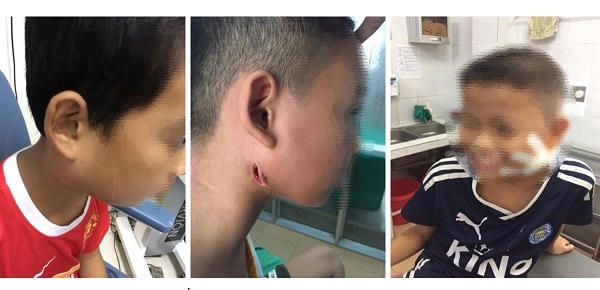 Phát hiện 3 bệnh nhi nhiễm vi khuẩn “ăn thịt người” ở Nghệ An