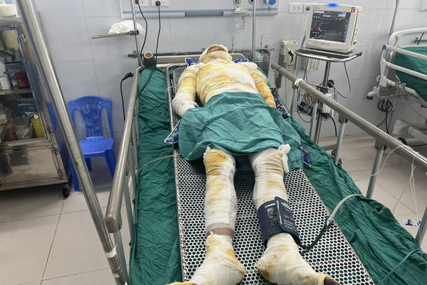 Bỏng gas cận kề cửa tử, cần lắm sự chung tay của những tấm lòng nhân ái