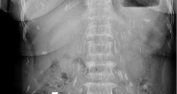 Nhập viện vì sán lá gan sinh sôi khắp cơ thể