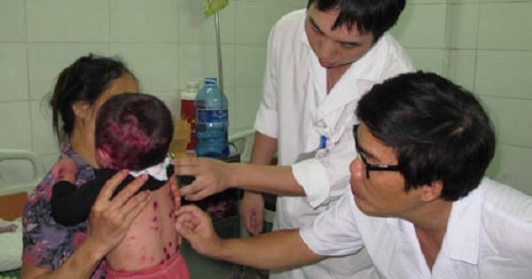 Thủy đậu vào mùa, trẻ em và phụ nữ có thai cần cẩn thận