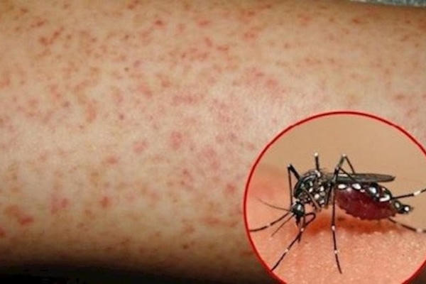 Hà Nội: Ghi nhận 612 ca mắc sốt xuất huyết và 26 ổ dịch