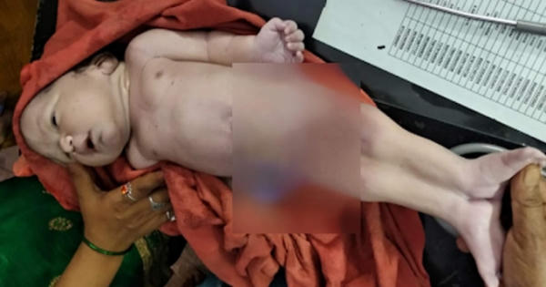 Bé trai 'người cá' chào đời ở Ấn Độ