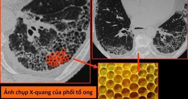 Virus corona mới tàn phá các bộ phận trên cơ thể như thế nào?