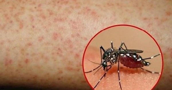 Phòng ngừa bệnh sốt xuất huyết trong mùa dịch cao điểm