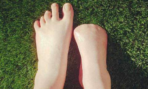 Người phụ nữ phải cắt bỏ 5 ngón chân vì để cá rỉa trong spa