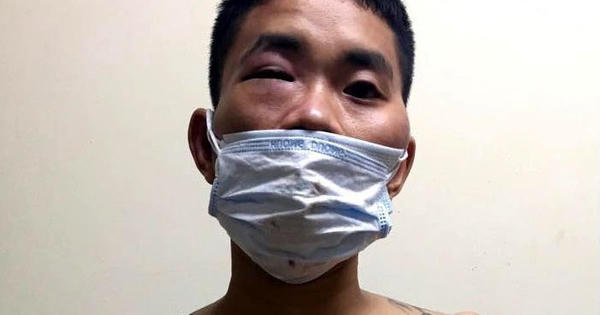 Bắt nam thanh niên có biểu hiện “ngáo đá” tấn công tổ công tác kiểm dịch