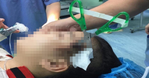 Xót xa hình ảnh bé gái bị bạn dùng kéo nhọn đâm vào đầu găm sâu 3cm