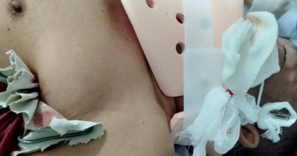 Kinh hoàng người đàn ông ngã từ cây nhãn bị thanh thép đâm xuyên từ nách qua cổ lên đến đỉnh đầu