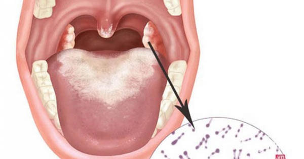 Đã có 20 trường hợp mắc bạch hầu, Bộ Y tế yêu cầu tăng cường phòng, chống