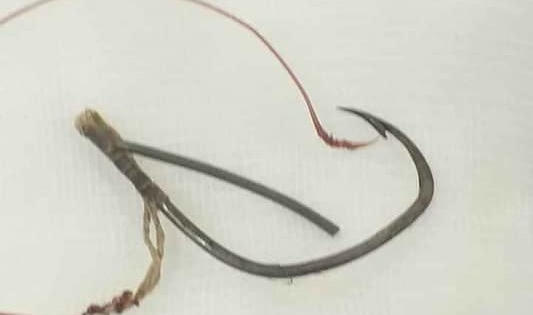 Người đàn ông được đưa đến bệnh viện với chiếc lưỡi câu móc thẳng vào mắt