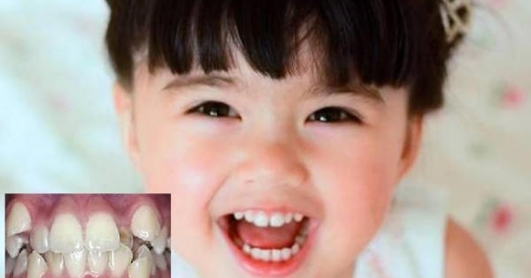 Răng trẻ mọc lệch do cha mẹ thờ ơ