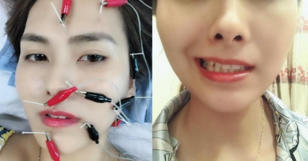 Tâm sự của cô gái bị méo mồm chỉ vì nằm ngủ bật điều hòa lạnh