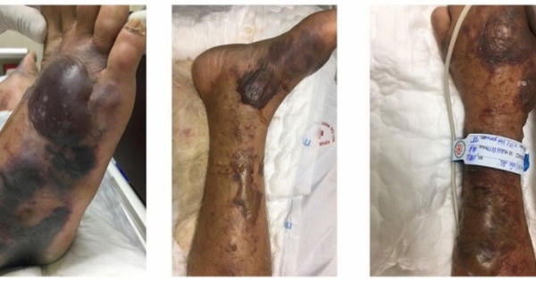 Cảnh báo 'vi khuẩn ăn thịt người' từ biển Cảnh báo 'vi khuẩn ăn thịt người' từ biển