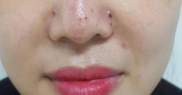 Người phụ nữ gặp biến chứng vì tiêm filler nâng mũi tại spa