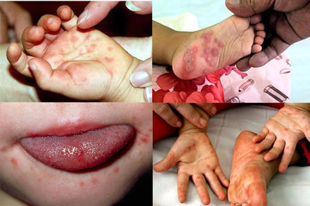 Thời tiết giao mùa cẩn trọng với bệnh tay chân miệng