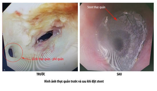 Bệnh nhân suýt chết vì mắc phải căn bệnh hiếm gặp ngày giáp Tết