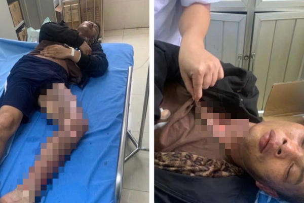 Leo trạm biến áp cắt trộm dây điện, hai người bị bỏng nặng