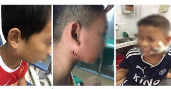 Virus Whitmore ăn mòn cơ thể có lây từ người sang người?