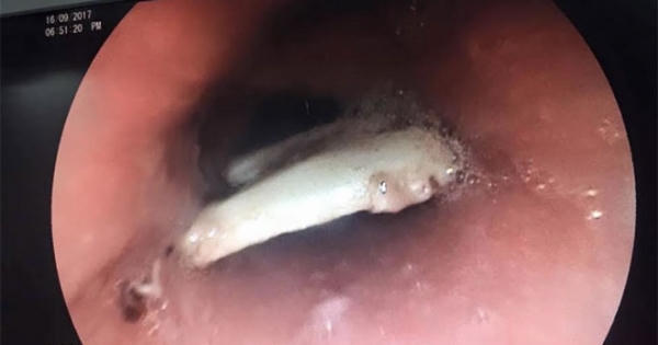 Gắp xương dài 2,5cm ra khỏi thực quản bệnh nhân Gắp xương dài 2,5cm ra khỏi thực quản bệnh nhân