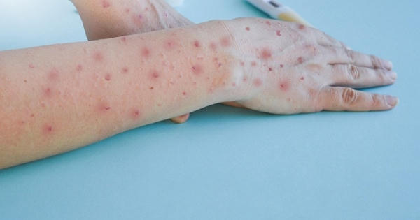 Cục Y tế dự phòng tăng cường kiểm soát, phòng chống bệnh đậu mùa khỉ