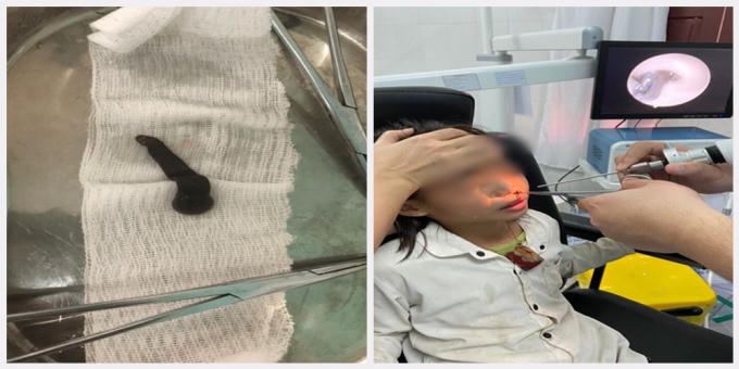 Gắp khỏi mũi xoang 2 bệnh nhi dị vật giống con đỉa dài gần 7cm