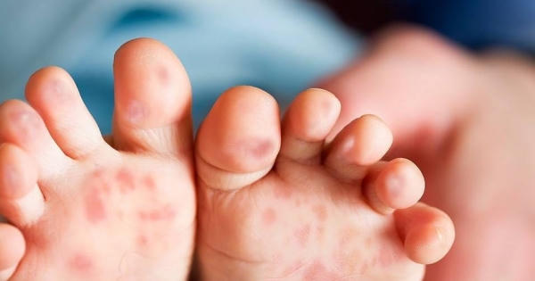 Các giải pháp phòng, chống bệnh tay chân miệng