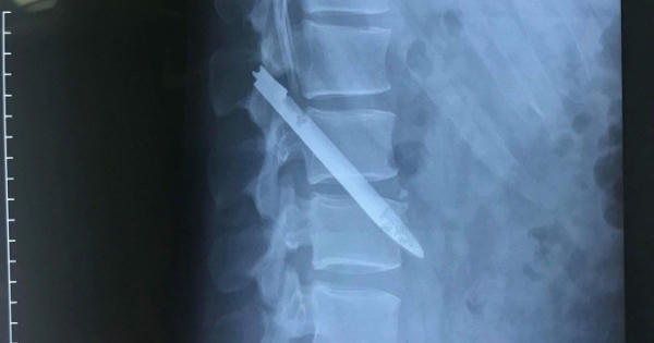 Một chiến sĩ công an phát hiện trong cơ thể mình có lưỡi dao dài đến 13 cm suốt 11 năm