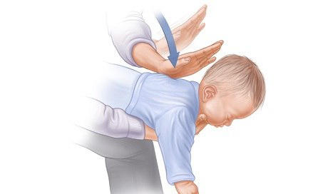 Sơ cứu nhanh, chuẩn khi trẻ sặc