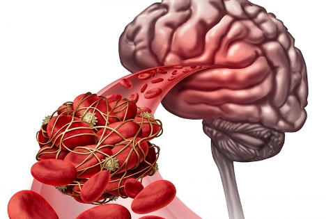 Tích lũy cục máu đông, tích lũy nguy cơ đột quỵ Tích lũy cục máu đông, tích lũy nguy cơ đột quỵ