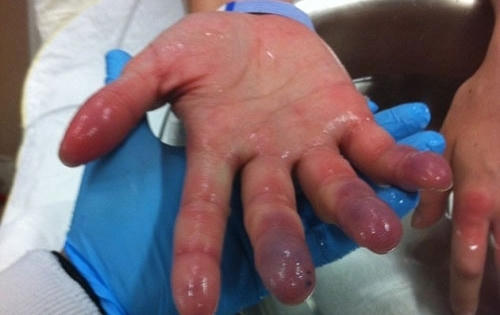 Ẩn họa khôn lường từ đá khô Ẩn họa khôn lường từ đá khô