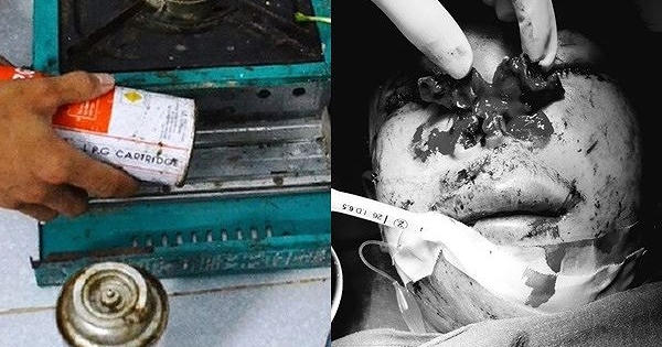 Nổ bình gas mini, người đàn ông cụt ngón tay, nam thanh niên vỡ toác mũi Nổ bình gas mini, người đàn ông cụt ngón tay, nam thanh niên vỡ toác mũi