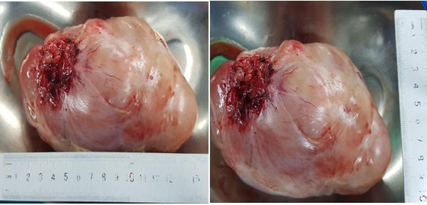 Phẫu thuật thành công bệnh nhân nữ 74 tuổi bị u lớn chèn ép tim phổi