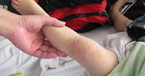 Hà Nội: Gia tăng trẻ mắc cúm A, giám sát tay chân miệng tại 63 bệnh viện Hà Nội: Gia tăng trẻ mắc cúm A, giám sát tay chân miệng tại 63 bệnh viện