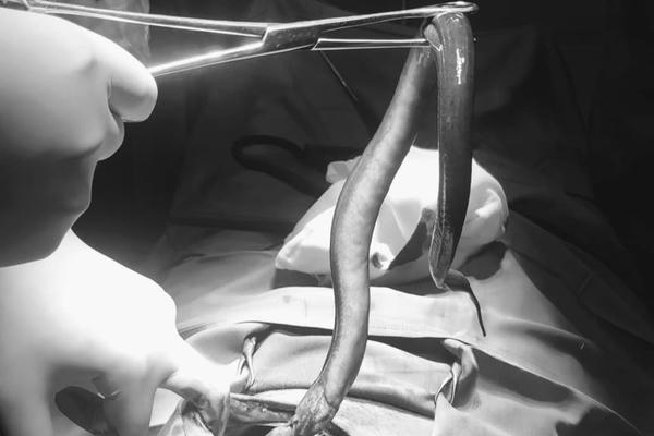 Cứu sống bệnh nhân bị con lươn dài 30 cm "quẫy" trong ổ bụng