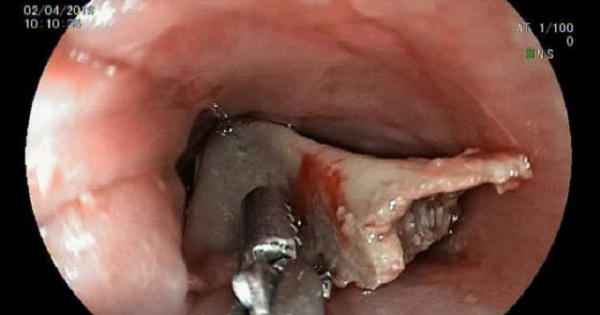 Xem ti vi khi ăn, bé gái bị khúc xương gà chặn ngang cổ