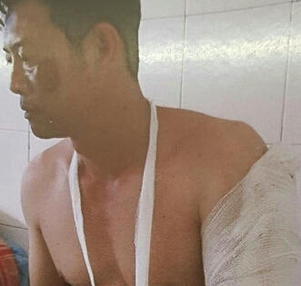 Lâm Đồng: Khởi tố chủ quán nhậu chém gần đứt cánh tay chủ nợ Lâm Đồng: Khởi tố chủ quán nhậu chém gần đứt cánh tay chủ nợ