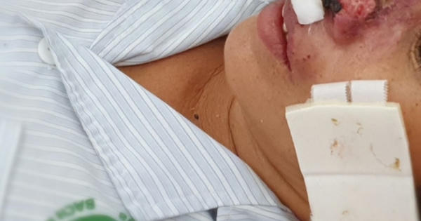 Sắp diễn ra Hội thảo Khoa học bệnh Whitmore toàn cầu lần thứ 9