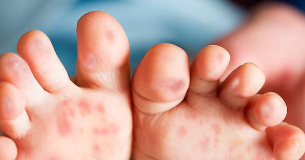 Sốt xuất huyết chưa qua, tay chân miệng lại đến