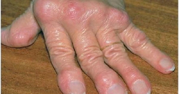 Thực đơn Tết cho người bị bệnh Gout